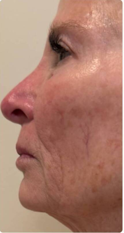 Before And After T Shape 2 Treatments 1