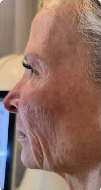 Before And After T Shape 2 Treatments 1