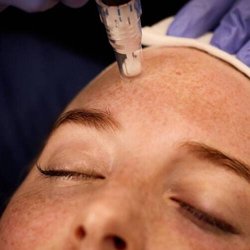 Skinpen Bts13